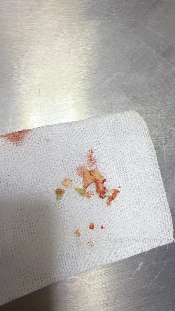 讨论/【科普】八岁小猫牙吸收 拔牙经验分享 - 线报酷